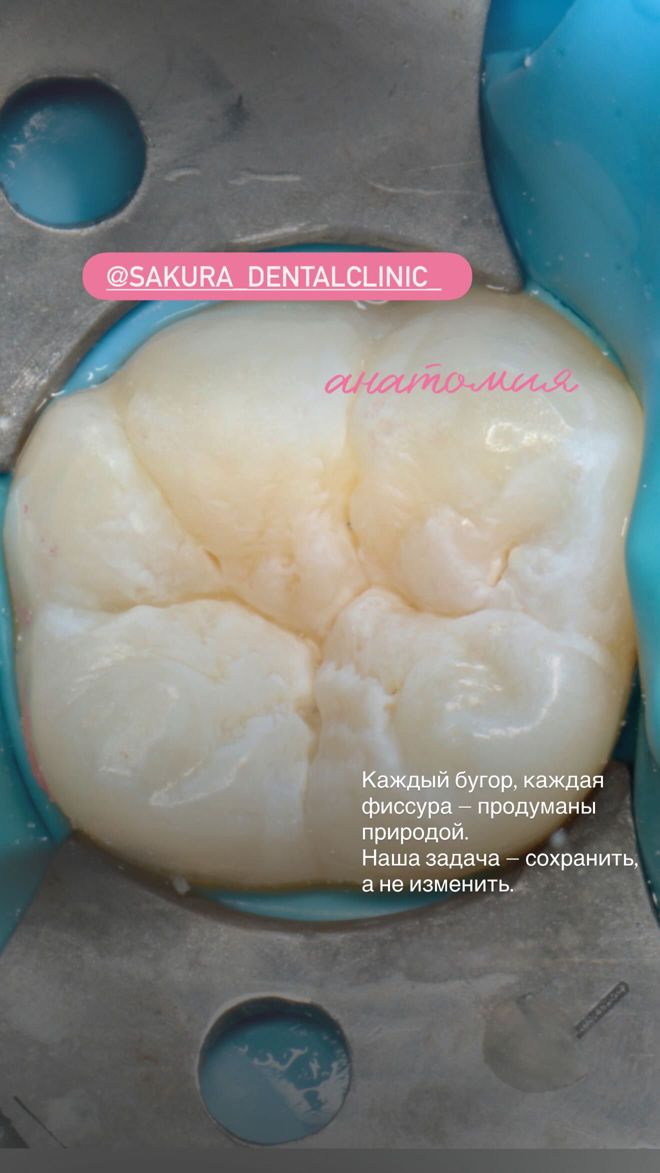 Лечение корневых каналов