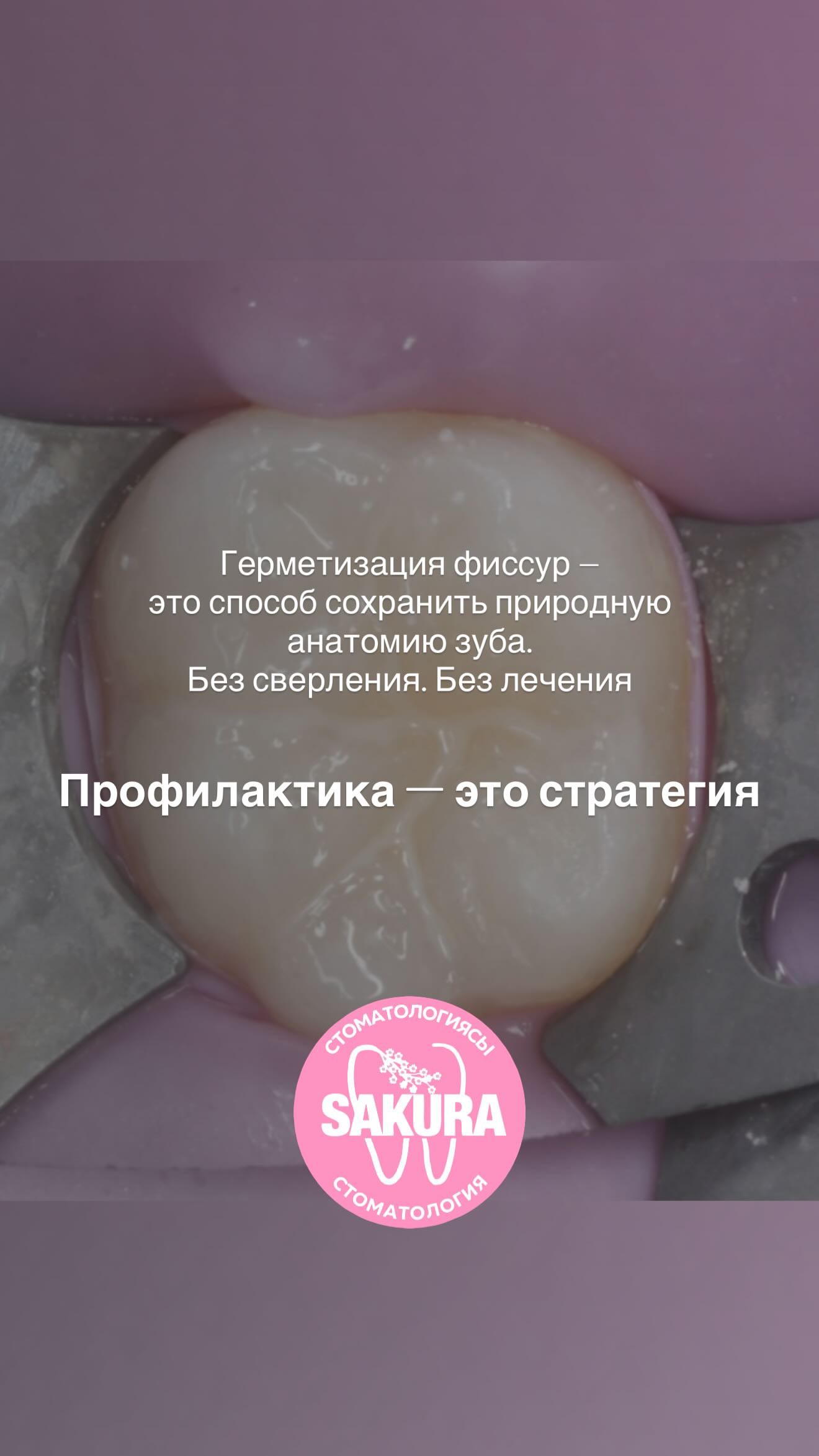 Герметизация фиссур