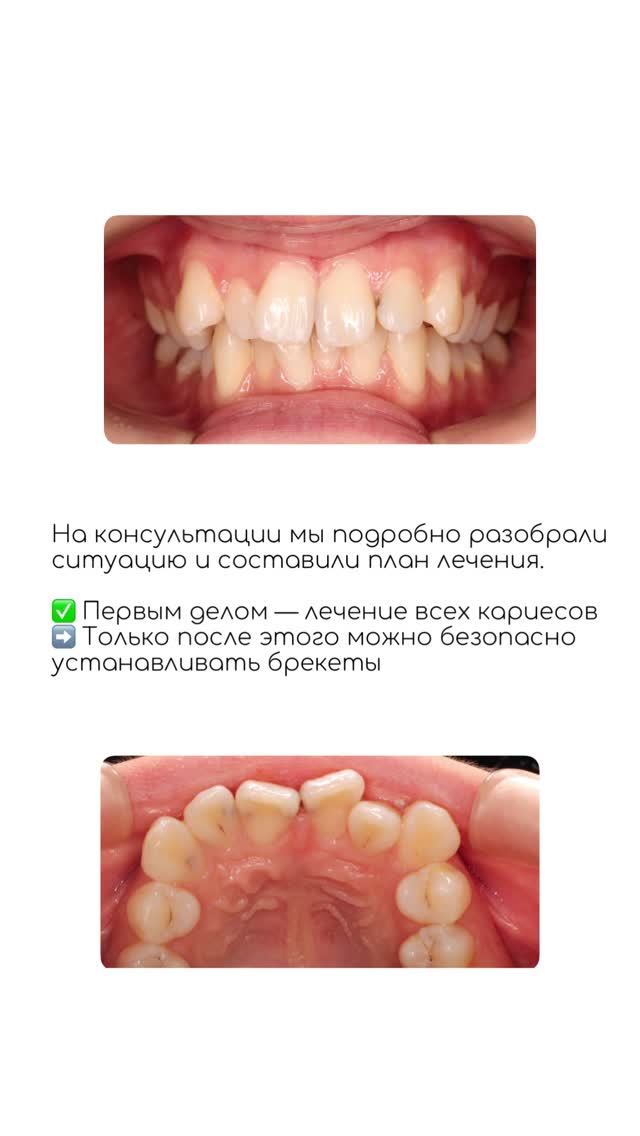 Ортодонтия — кейс