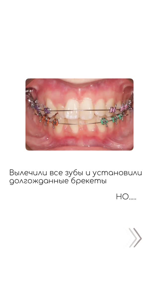 Кейс ортодонтии