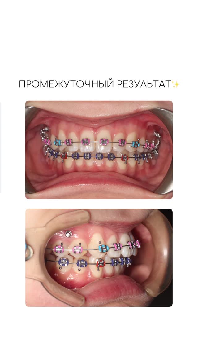 Кейс ортодонтии — результат