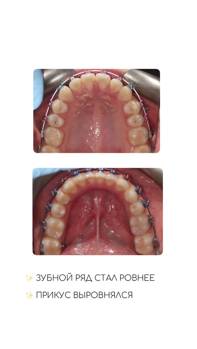 Кейс брекет-системы